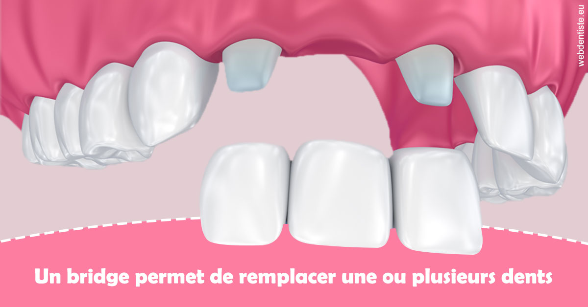 https://www.dr-necula.fr/Bridge remplacer dents 2