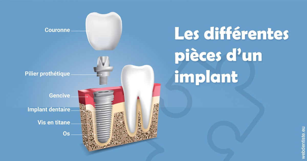 https://www.dr-necula.fr/Les différentes pièces d’un implant 1